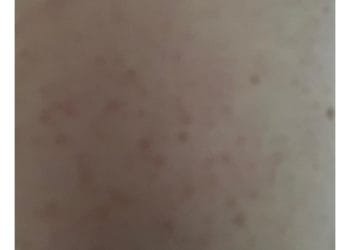 Home Remedies for Acne