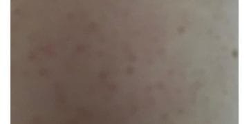 Home Remedies for Acne