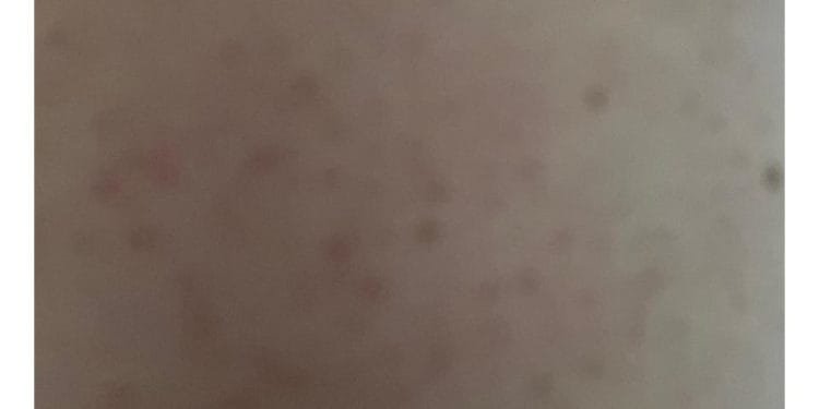 Home Remedies for Acne